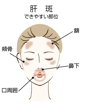 肝斑とは?