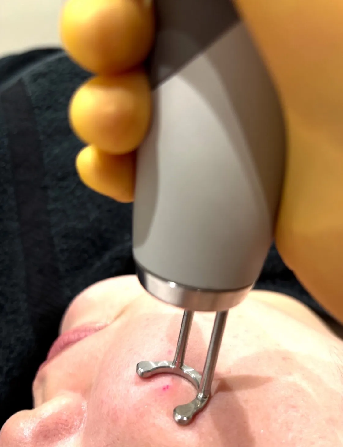 ピコフラクショナル