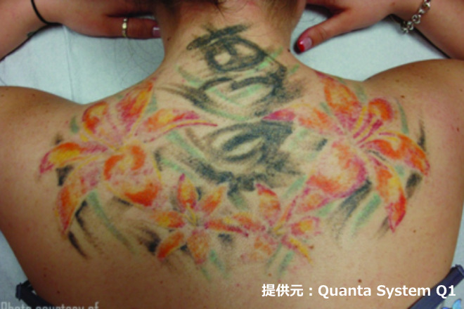 ピコレーザーによるタトゥー除去