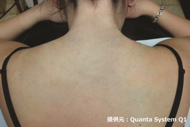 ピコレーザーによるタトゥー除去