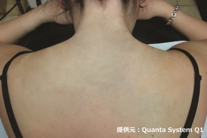 ピコレーザーによるタトゥー除去 治療後計10回