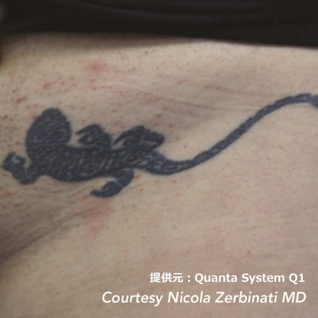 ピコレーザーによるタトゥー除去