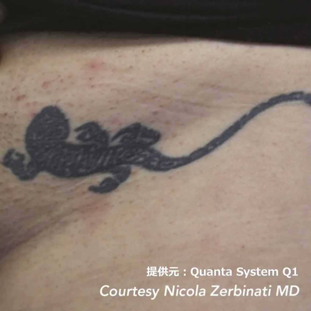 ピコレーザーによるタトゥー除去 治療前