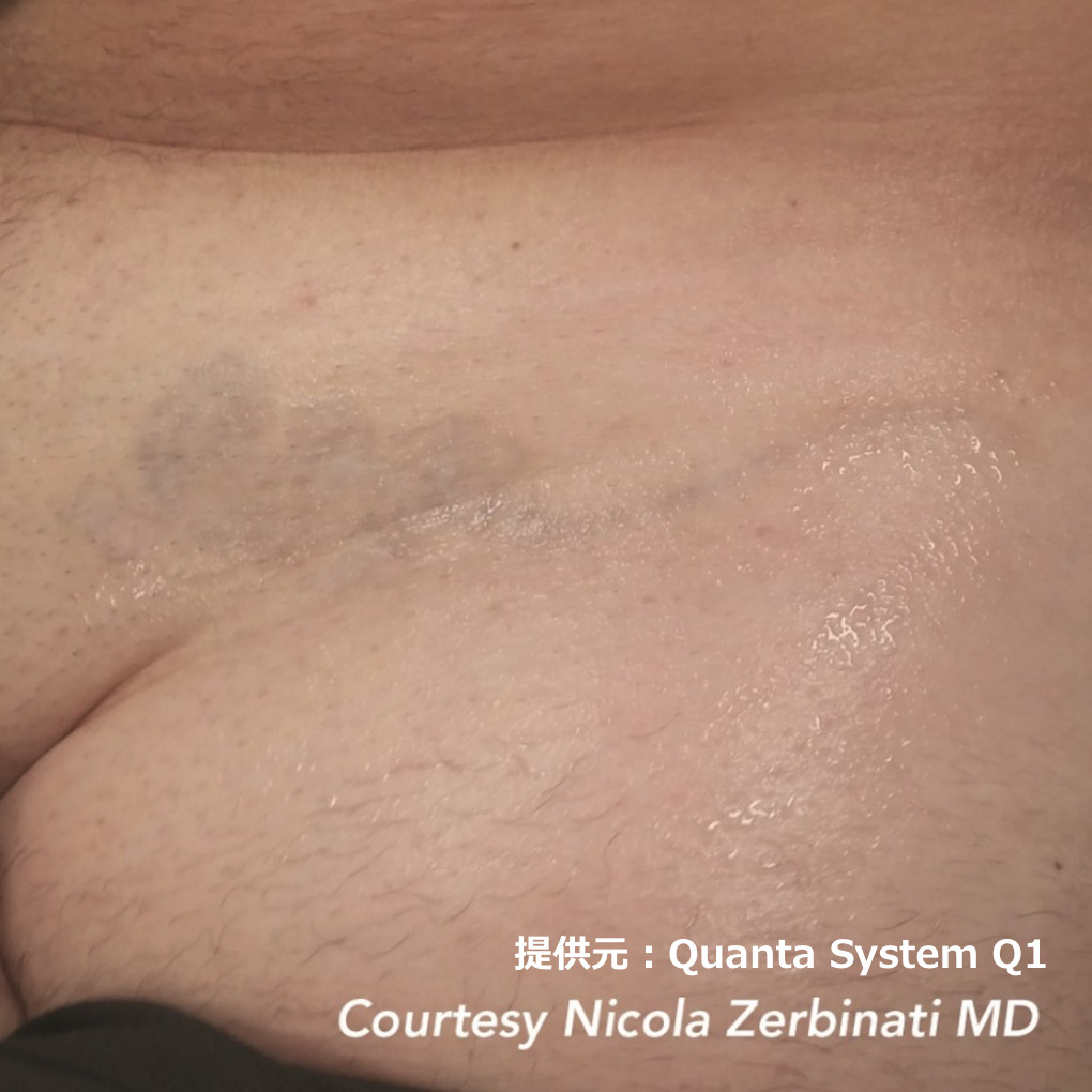 ピコレーザーによるタトゥー除去