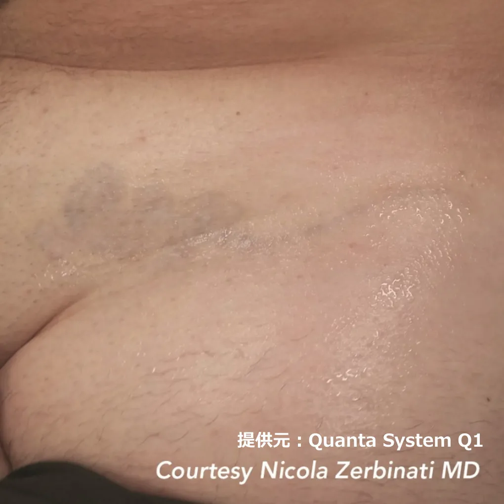 ピコレーザーによるタトゥー除去 治療後10回