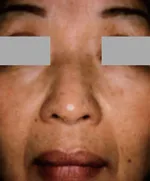 外用トレチノイン療法1