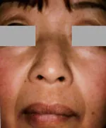 外用トレチノイン療法2