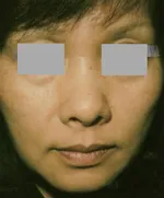 外用トレチノイン療法4